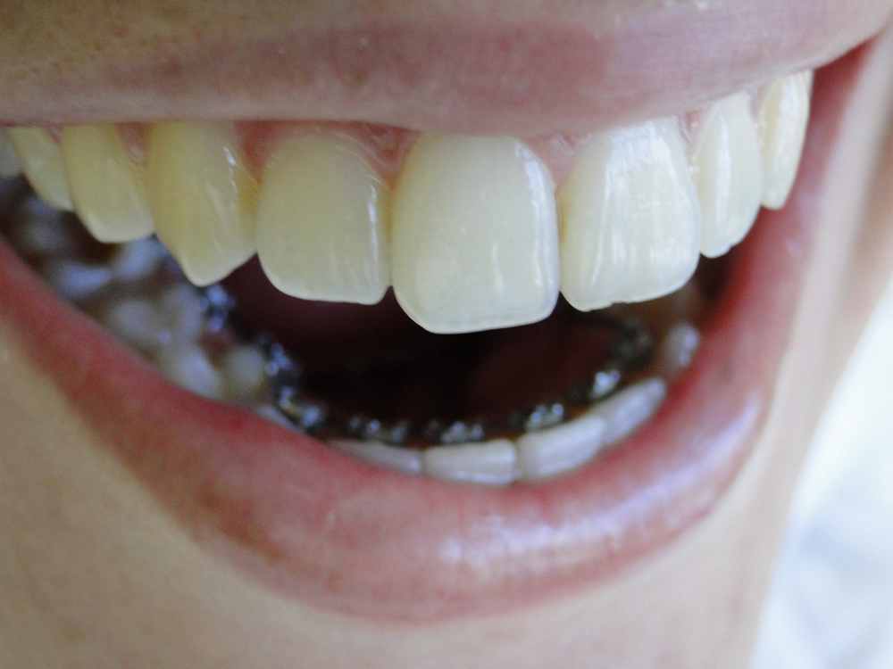 O Tratamento com Invisalign é indicado para todos os pacientes que precisam  corrigir a posição dos dentes e ou a estética do sorriso. - COI