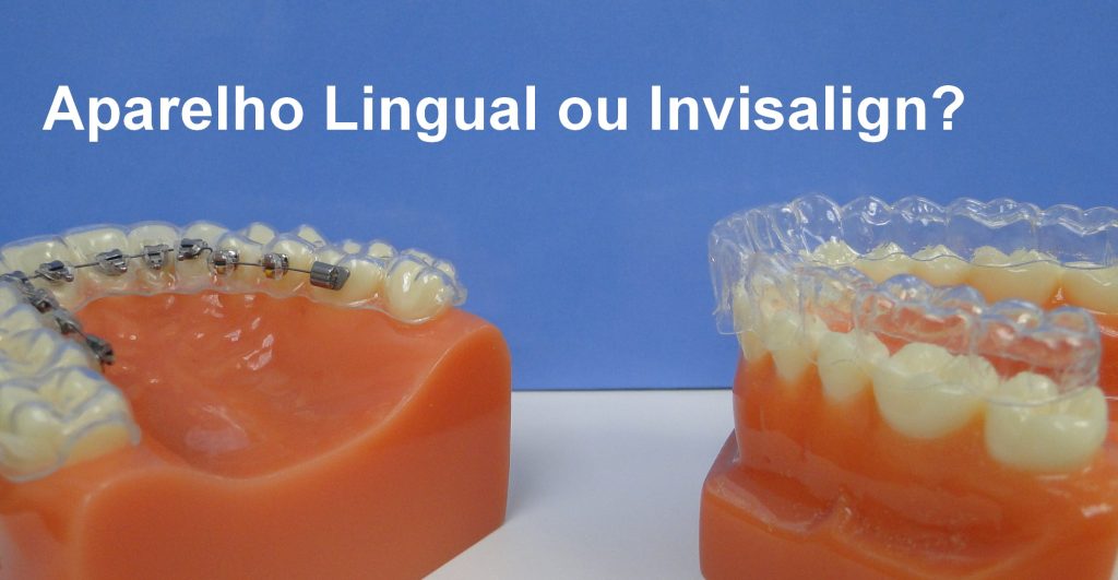 Aparelho dentário invisível: 4 Vantagens do Invisalign