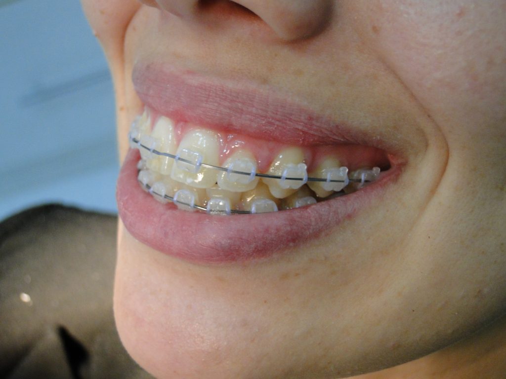 Aparelhos de cerâmica: Prós e Contras - Dentalis