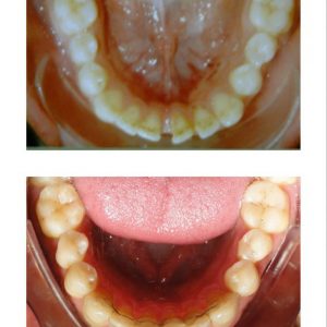 Fechamento De Diastemas Ortodontia E Restaura Es