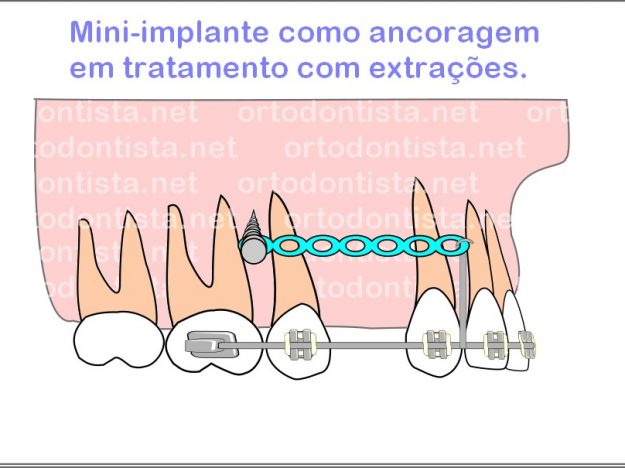 Aparelhos ortodônticos Ortodontista net