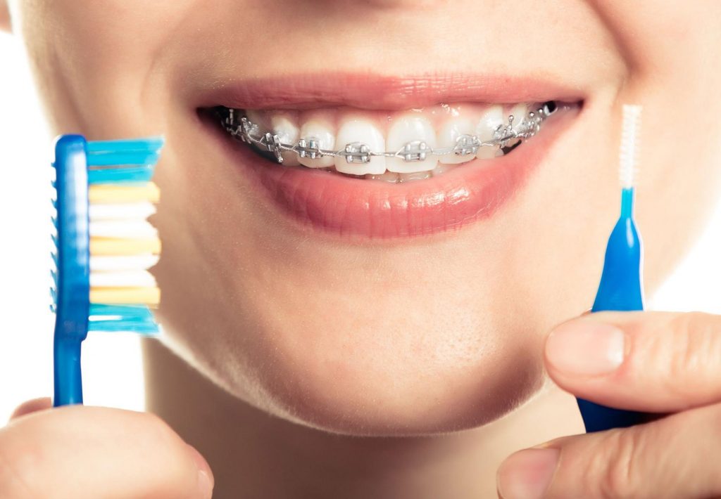 Quando é possível perceber os resultados com o Alinhador Invisível?  Confira! - Dental Arte