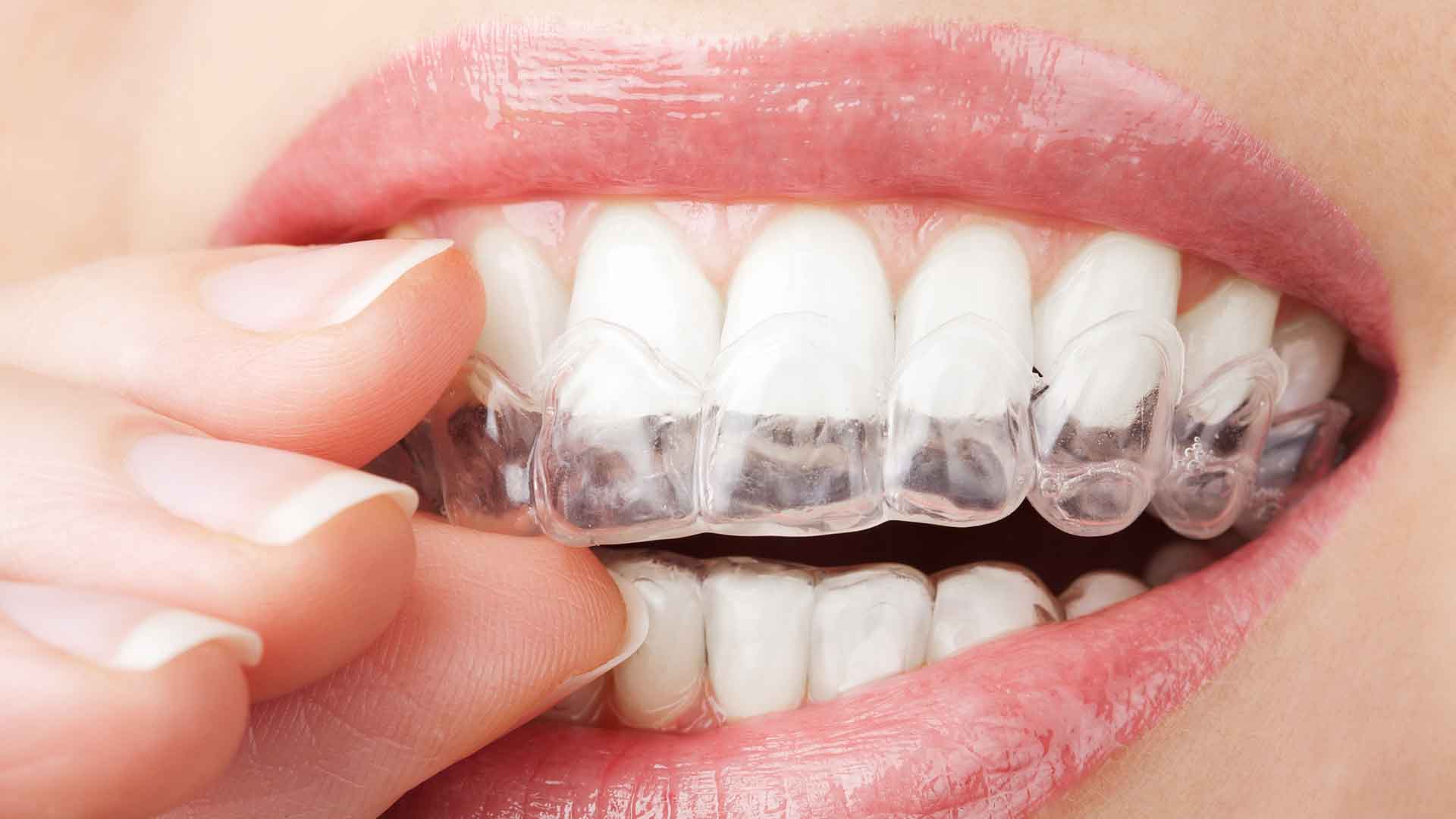 Alinhador Invisível – Orthofono Odontologia