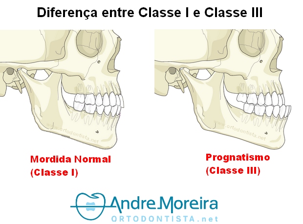 Retrognatismo: O Que Você Precisa Saber [por um especialista]