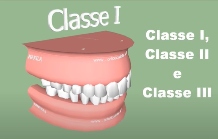 O Prognatismo da minha filha: O que é Prognatismo Mandibular