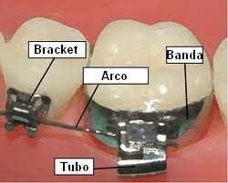 aparelho-fixo-banda-e-tubo-ortodontico