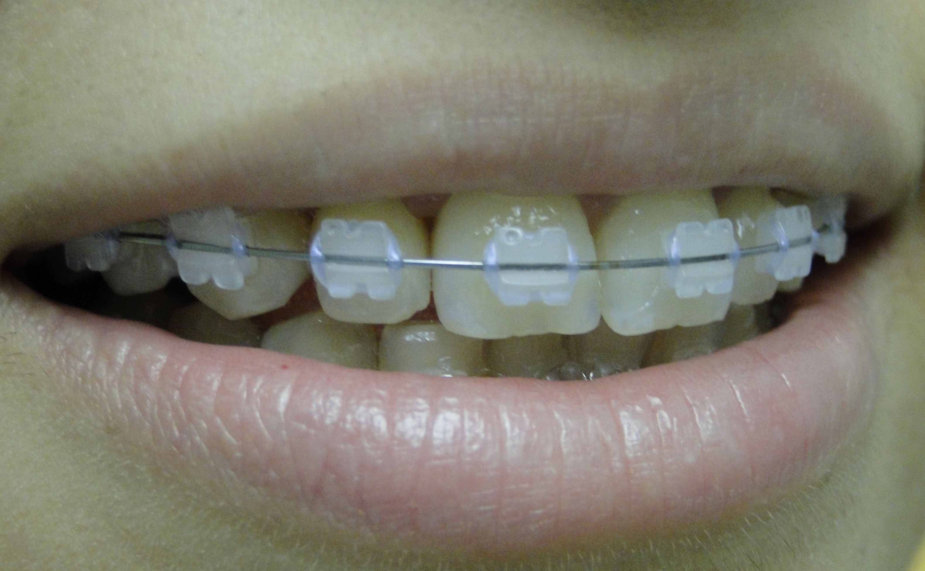 Dr. Leonardo Brasil - Invisalign em Recife - Clareamento Dental