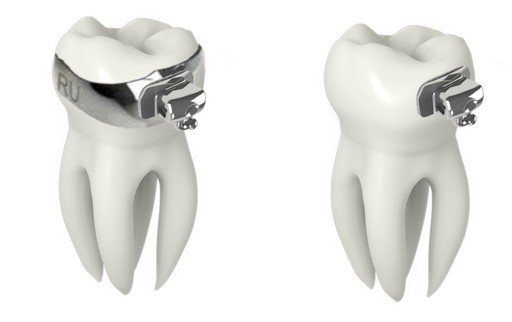 molares-com-tubo-ortodontico.jpg