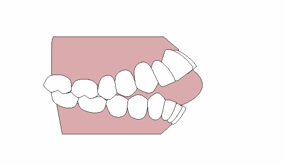 Boca Aberta Com Língua Para Fora E Dentes Incisivos Superiores