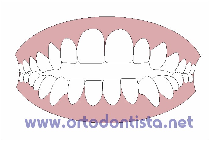 Homem Mandíbula Ou Maxilar Osso Com Dentes Em Três Quartos De