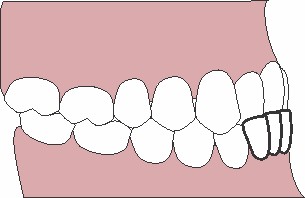 Próteses dentárias de um único molar projetadas por IA