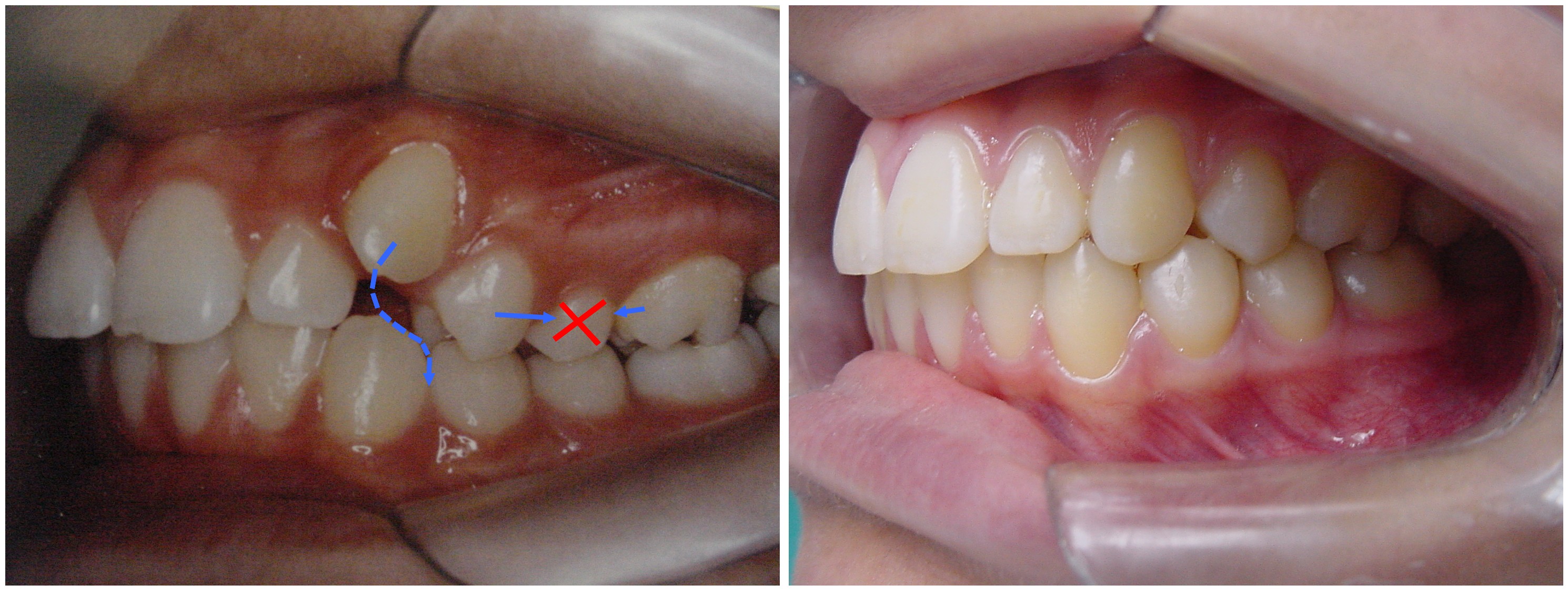 Featured image of post Dente Encavalado Da Frente Que est o montados sobrepostos normalmente em cavalos