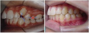 tratamento ortodôntico com extração de pre-molares