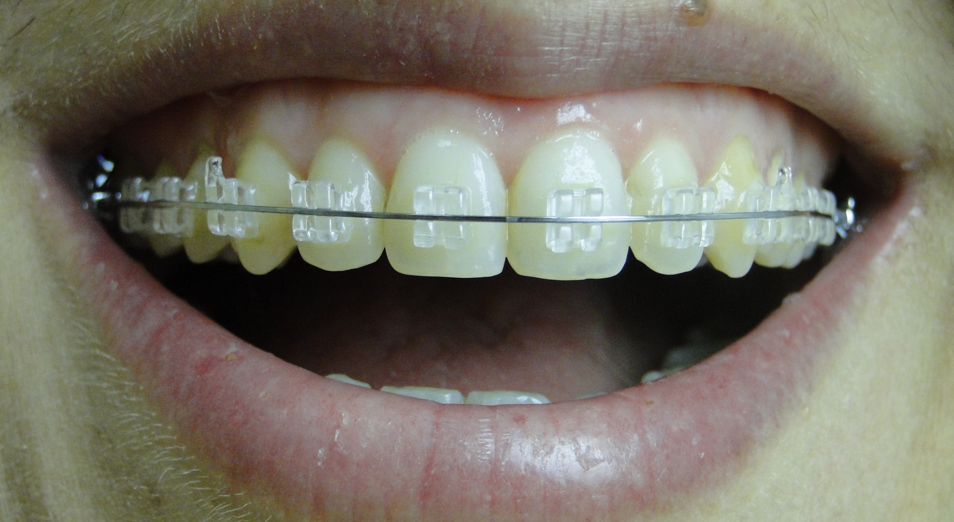 Invisalign: O aparelho dental invisível, Dra. Cristina Pinheiro