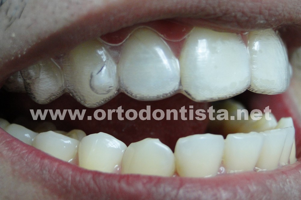 Alinhador transparente invisalign versus aparelho ortodôntico tradicional -  Instituto Caiado - Odontologia
