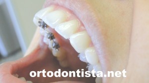 ortodontia lingual - aparelho superior visto pela lateral