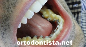  ortodontia lingual inferior