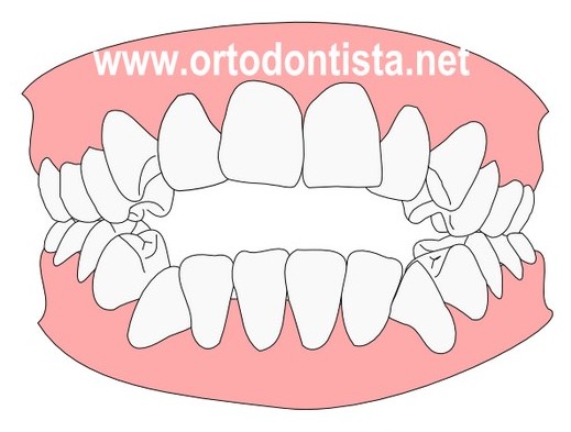 O Prognatismo da minha filha: O que é Prognatismo Mandibular