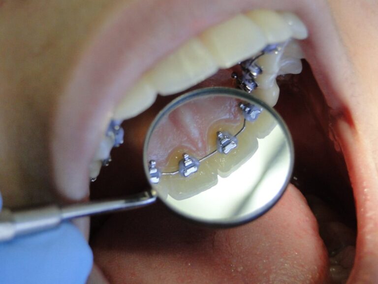 Dsc04418 Aparelho lingual convencional - foto 08