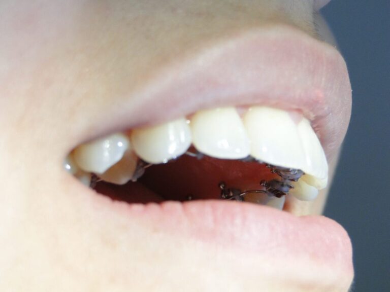 Dsc04420 Aparelho lingual convencional - foto 06