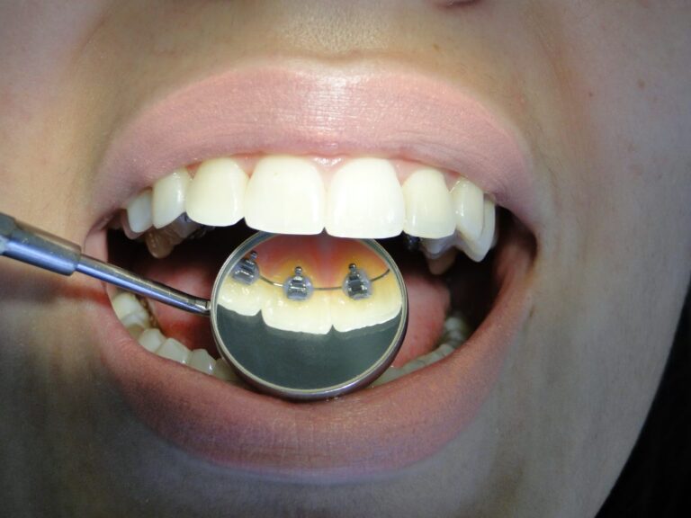 Dsc04424 e1507316574457 Aparelho lingual convencional - foto 05