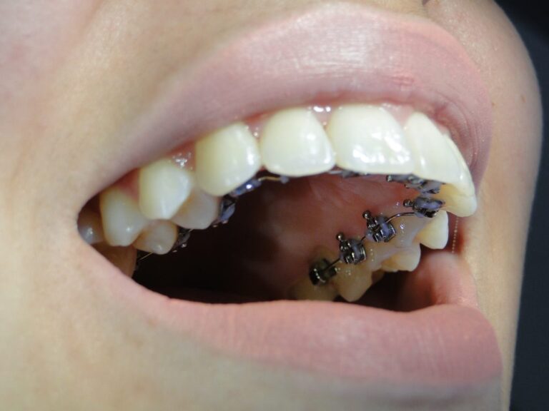 Dsc04427 e1507316498740 Aparelho lingual convencional - foto 04