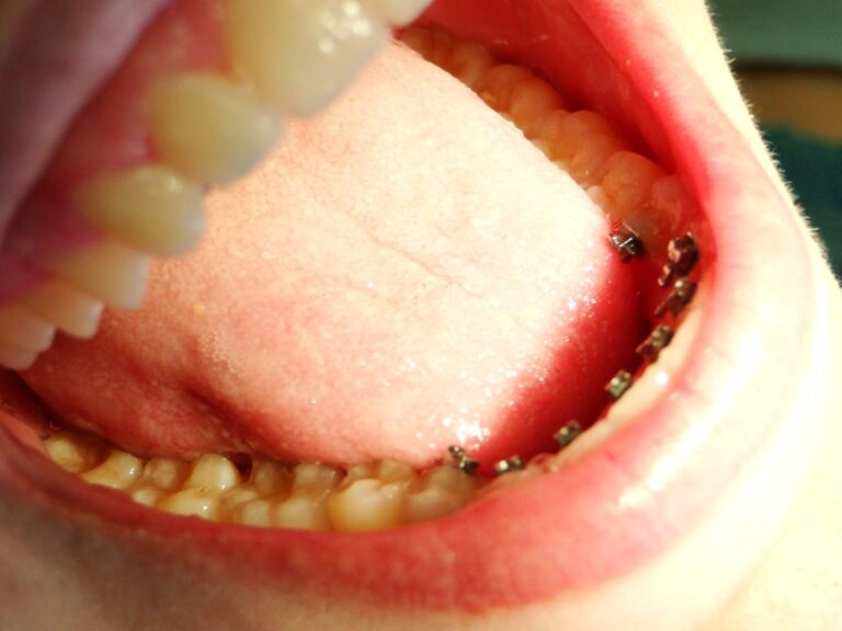 Dsc04471 Aparelho lingual convencional - foto 13