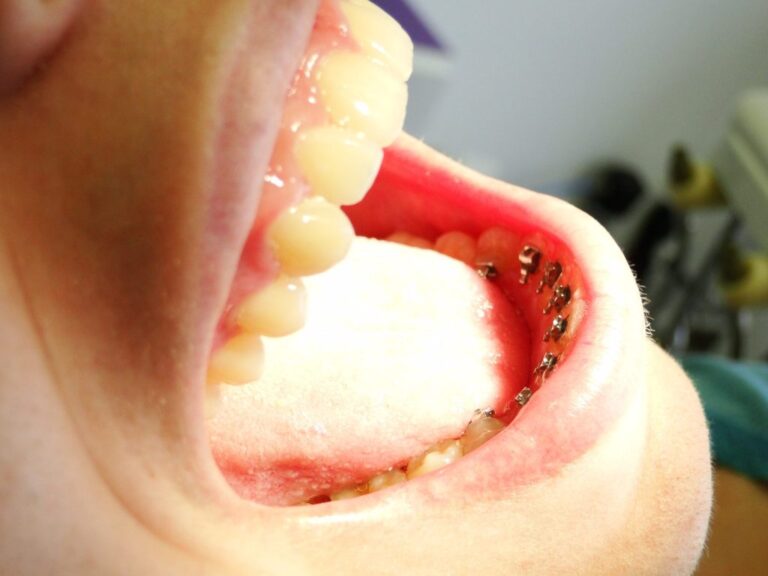 Dsc04472 Aparelho lingual convencional - foto 12