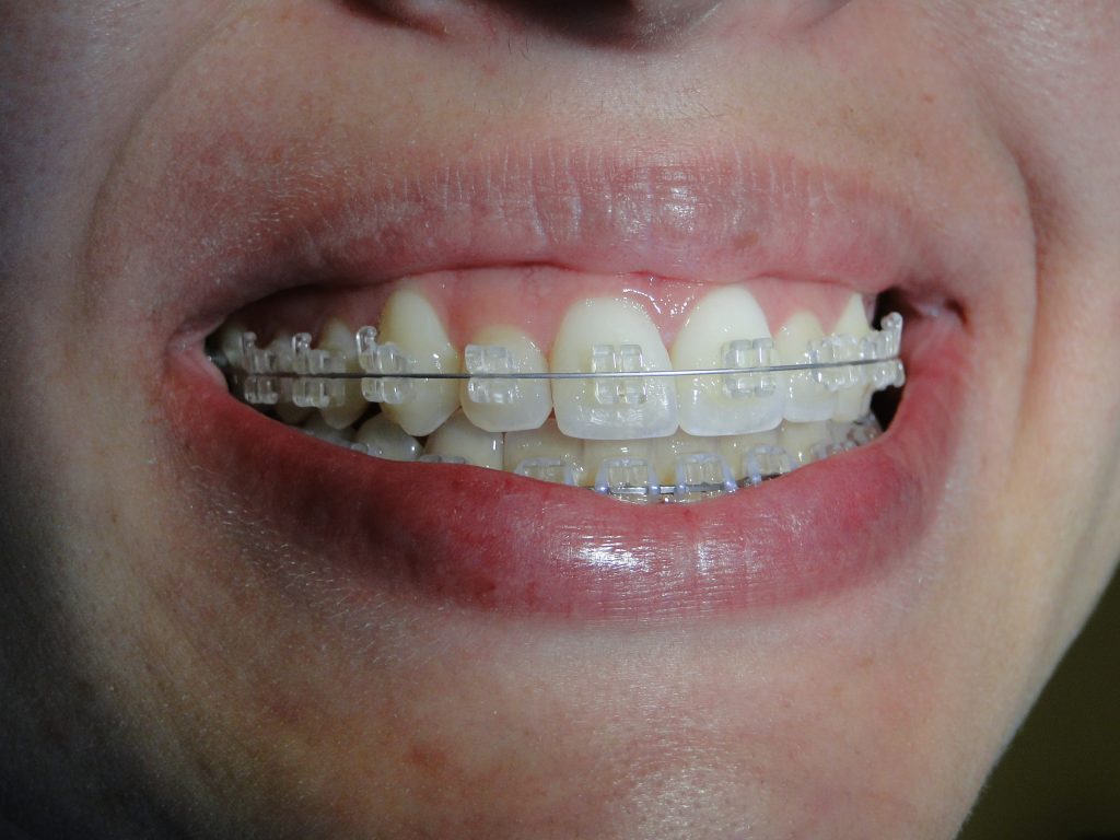 Featured image of post Dente Encavalado Feio N o tinha problema de mordida nem dente encavalado nada disso