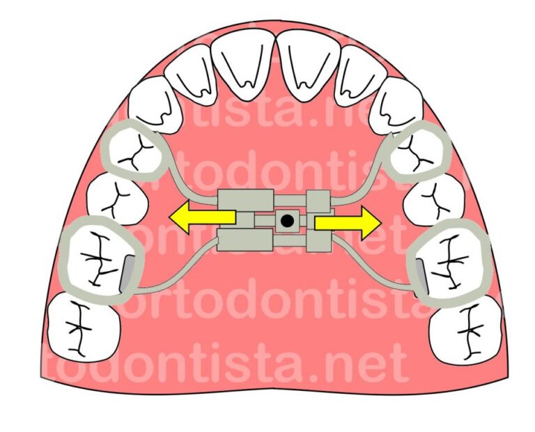 Disjuntor palatino hirax Expansores e disjuntores - foto 02
