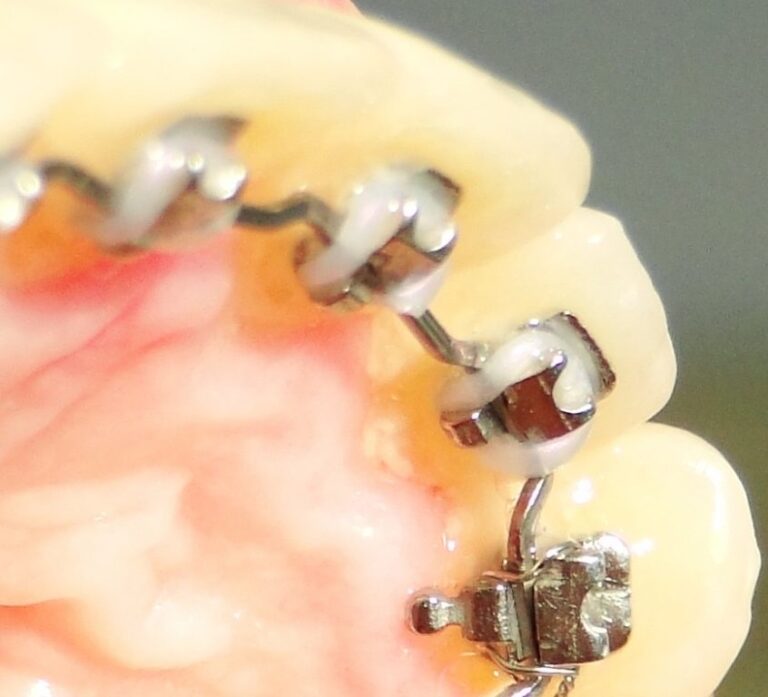 Aparelho lingual convencional 6 Aparelho lingual convencional 6