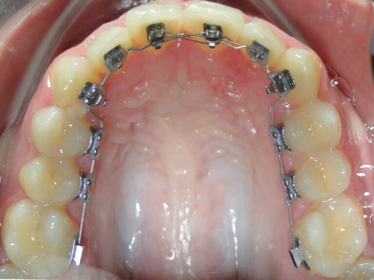 Aparelho lingual convencional Aparelho lingual convencional