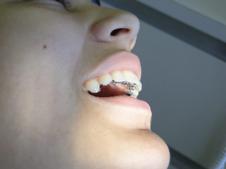 Aparelho lingual convencional foto 01 Aparelho lingual convencional - foto 01