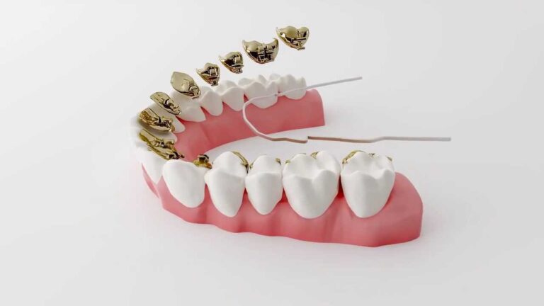 Incognito 2 Aparelho lingual prototipado incognito - foto 02