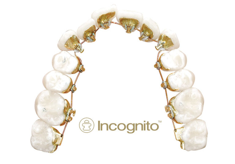 Incognito 3 Aparelho lingual prototipado incognito - foto 01