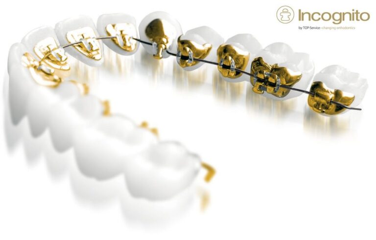 Incognito Aparelho lingual prototipado incognito - foto 04