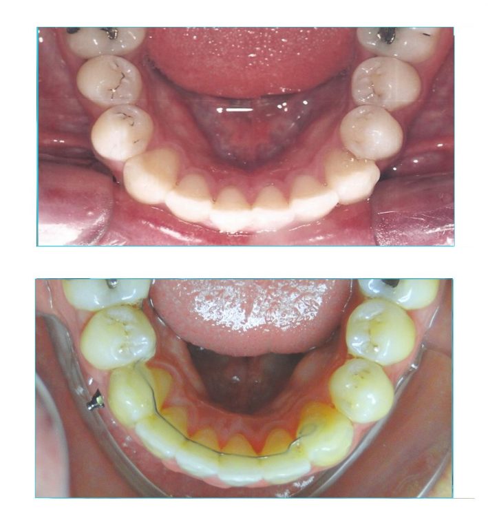 Prognatismo mandibular