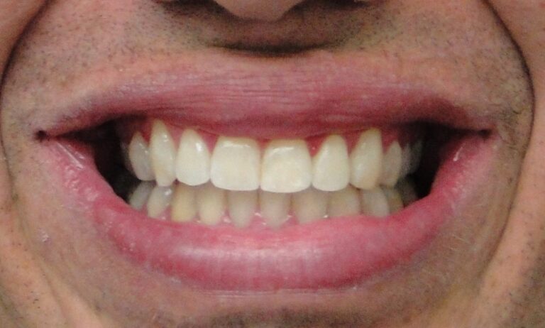 Tratamento compensatorio de prognatismo sorriso Tratamento compensatório de prognatismo sorriso