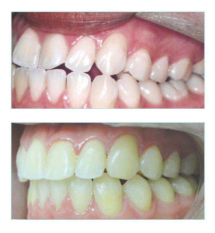 Tratamento compensatorio de prognatismo vista esquerda Tratamento compensatório de prognatismo vista esquerda