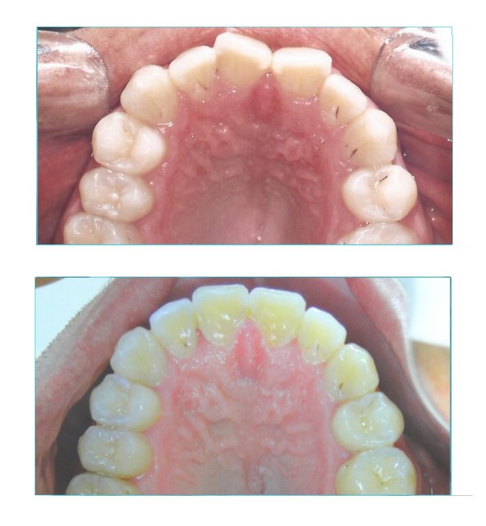 Tratamento compensatorio de prognatismo vista superior Tratamento compensatório de prognatismo vista superior