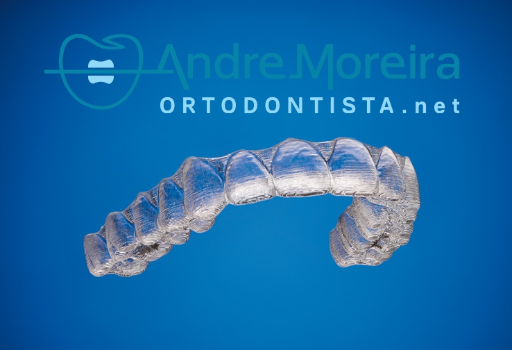 Glassline: O alinhador invisível da OrthoDontic - Blog - OrthoDontic Sorria  Sempre