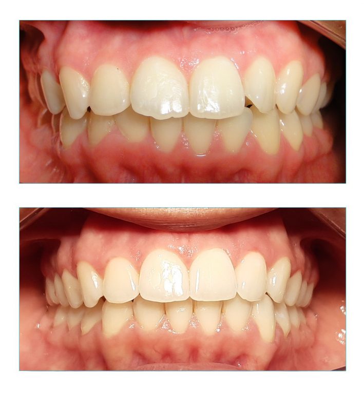 Correcao de mordida profunda com aparelho lingual vista frontal Correção de mordida profunda com aparelho lingual vista frontal