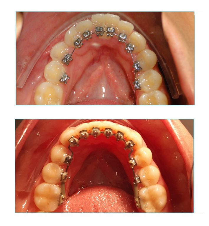 Correcao de mordida profunda com aparelho lingual vista inferior Correção de mordida profunda com aparelho lingual vista inferior