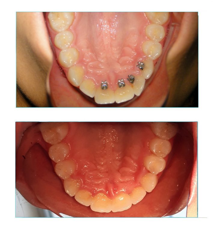 Correcao de mordida profunda com aparelho lingual vista superior Correção de mordida profunda com aparelho lingual vista superior